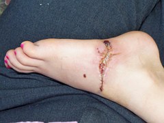 foot injury