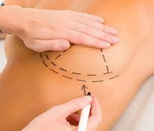 breast augmentation