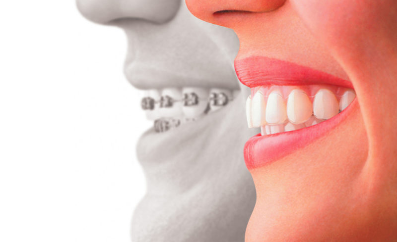 teeth without braces and with braces